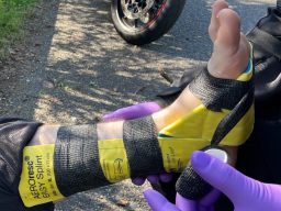 DRRS Imobilisation Schienung einer Fußgelenksfraktur mit einem Splint System
